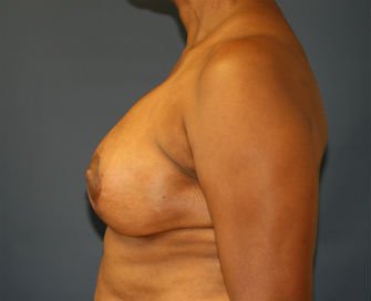 Breast Lift San Diego Case 18 - after - side