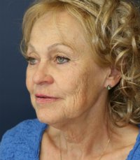 Facelift San Diego Case 22 - before - oblique