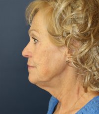 Facelift San Diego Case 22 - before - side