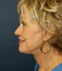 Facelift San Diego Case 22 - after - side