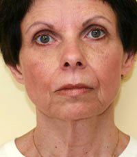 Facelift Case 10 - before - front