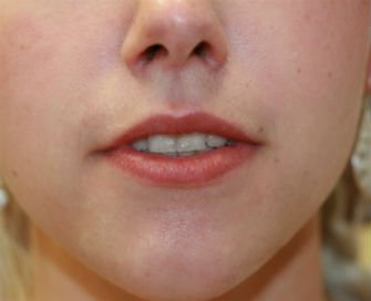 Juvederm into lips - before - front