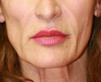 Lips San Diego Case 16 - before - front