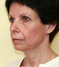 Facelift Case 10 - before - angle