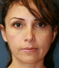 Rhinoplasty 34 (Tip Only) - after - front