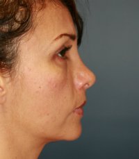Rhinoplasty 34 (Tip Only) - after - side