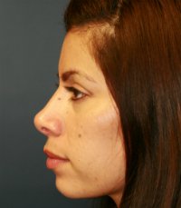 Rhinoplasty San Diego Case 35 - after - front
