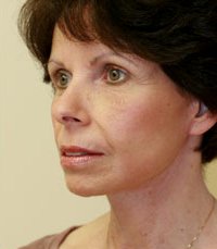 Facelift Case 10 - after - angle
