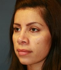 Rhinoplasty San Diego Case 35 - after - oblique
