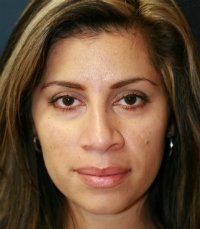 Rhinoplasty San Diego Case 35 - before - side