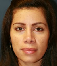Rhinoplasty San Diego Case 35 - after - side