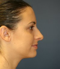 Rhinoplasty San Diego 27 - before - side