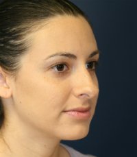 Rhinoplasty San Diego 27 - before - oblique