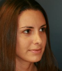 Rhinoplasty San Diego 27 - after - oblique