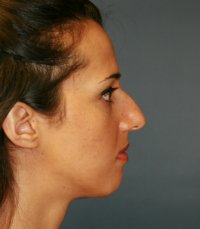 Rhinoplasty case 21 - before - front