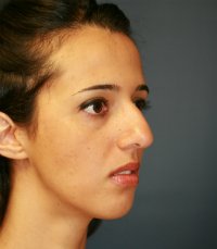 Rhinoplasty case 21 - before - oblique