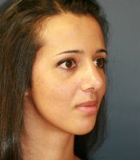 Rhinoplasty case 21 - after - oblique