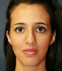 Rhinoplasty case 21 - before - side