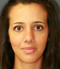 Rhinoplasty case 21 - after - side