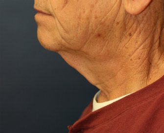 Necklift San Diego Case 20 - before - front