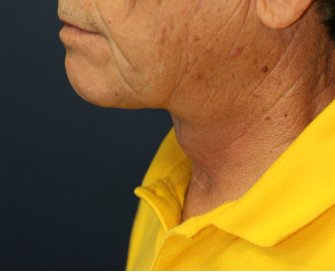 Necklift San Diego Case 20 - after - front