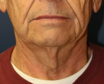 Necklift San Diego Case 20 - before - side