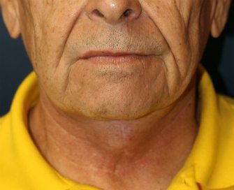 Necklift San Diego Case 20 - after - side