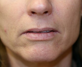Lips San Diego Case 17 - before - front