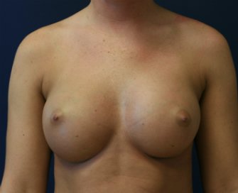 Breast Augmentation San Diego Case 68 - after - front