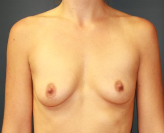 Breast Augmentation San Diego Case 69 - before - front