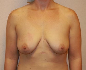 Breast Augmentation San Diego Case 70 - before - front