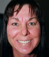 Laser skin treatment San Diego case 1 - before - front
