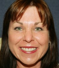 Laser skin treatment San Diego case 1 - after - front