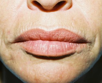 Laser skin treatment San Diego case 2 - before - front
