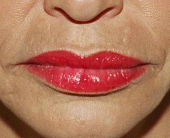Laser skin treatment San Diego case 2 - after - front