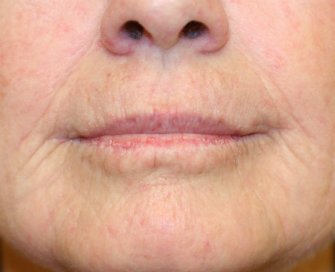 Laser skin treatment San Diego case 3 - before - front