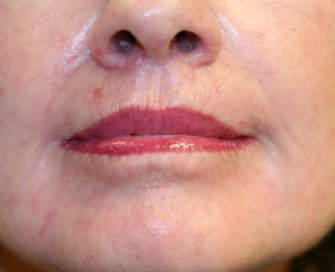 Laser skin treatment San Diego case 3 - after - front
