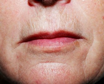 Laser skin treatment San Diego case 4 - before - front