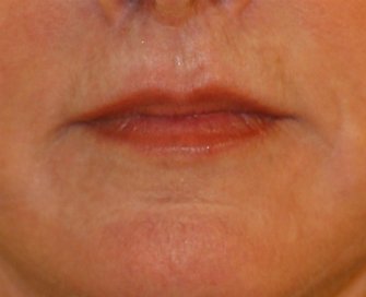 Laser skin treatment San Diego case 4 - after - front