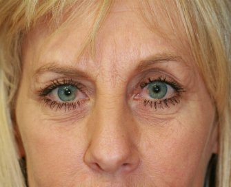 Laser skin treatment San Diego case 6 - before - front