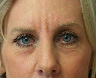 Laser skin treatment San Diego case 6 - after - front