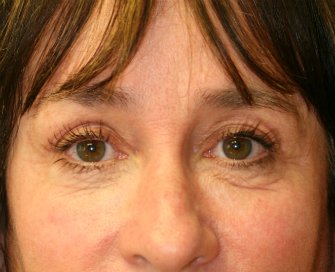 Laser skin treatment San Diego case 5 - before - front