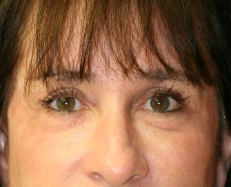 Laser skin treatment San Diego case 5 - after - front