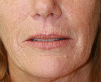 Laser skin treatment San Diego case 7 - before - front