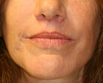Laser skin treatment San Diego case 7 - after - front