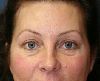 Eyelid Surgery San Diego Case 50 - before - front