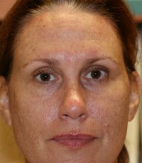 Botox-Dysport-Xeomin - before - front