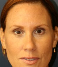 Botox-Dysport-Xeomin - after - front