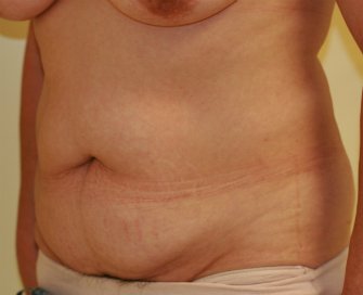 Tummy Tuck Case 17 - before - oblique