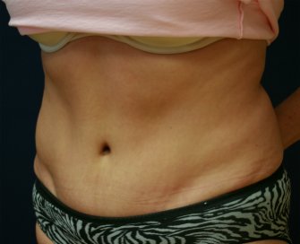 Tummy Tuck Case 17 - after - oblique